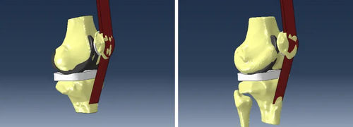 Software de análisis - Abaqus Knee Simulator - SIMULIA - de simulación / de modelización / de diseño