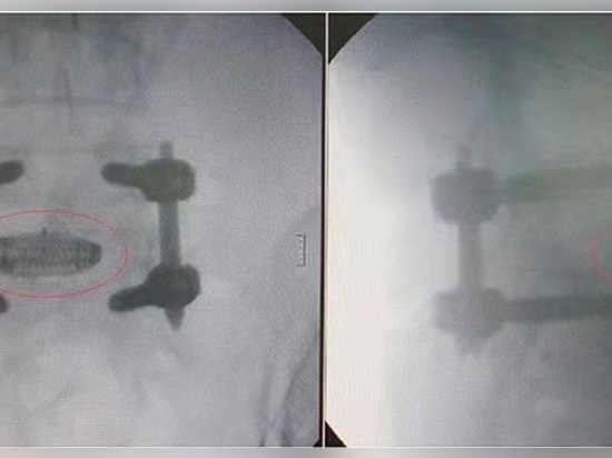 Fabricación de implantes de columna vertebral con la impresora 3D de metal EP-M250